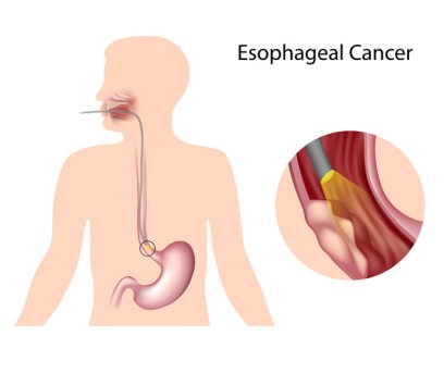 High Dose Rate Brachytherapy for Esophageal Cancer by OrangeCountySurgeons